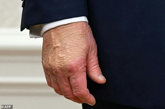 103347581-15231359-A_close_up_shows_US_President_Donald_Trump_s_right_hand_with_hea-a-1_1761575883384.jpg