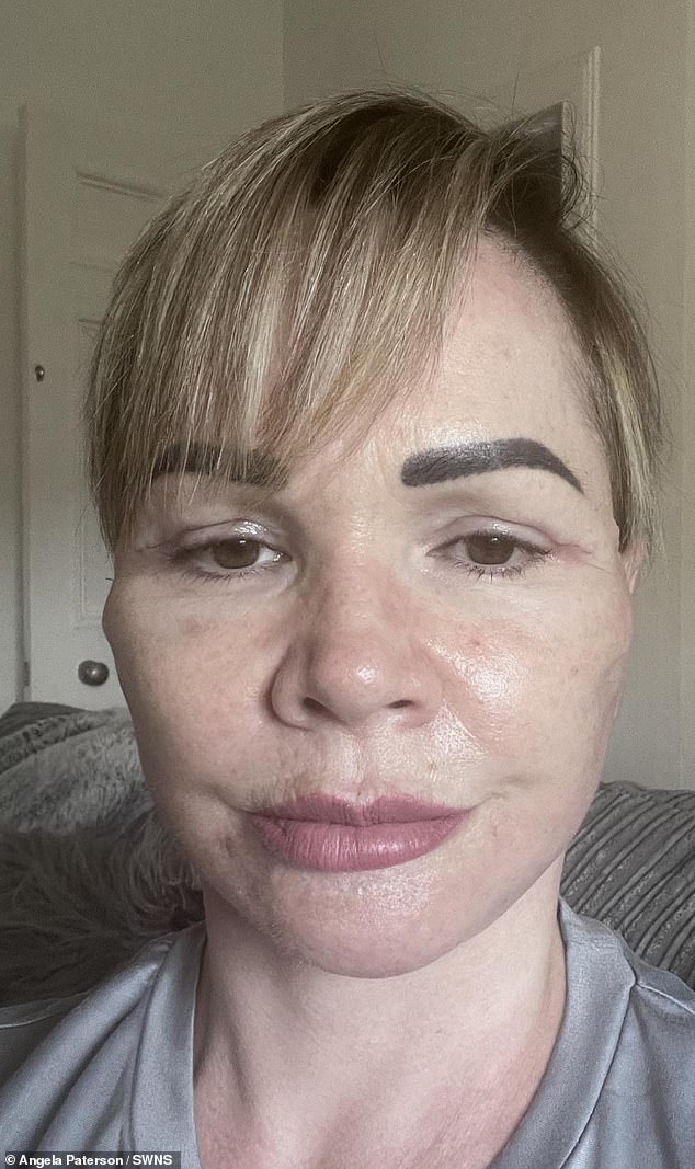 Una empresaria que voló a Lituania para hacerse un lifting facial y de cuello por valor de £7.000 dice que tiene cicatrices, problemas de audición y la boca abierta.