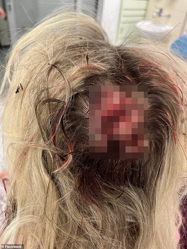 La enfermera ‘atacada por un migrante afgano con una palanca’ revela que fue ‘casi muerta a golpes’ mientras revela sus horribles heridas