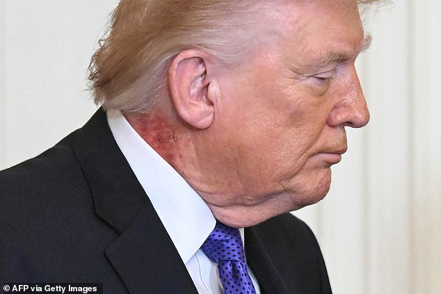 Trump provocó nuevos temores de salud después de que los espectadores detectaran un problema “desagradable” en su cuello.