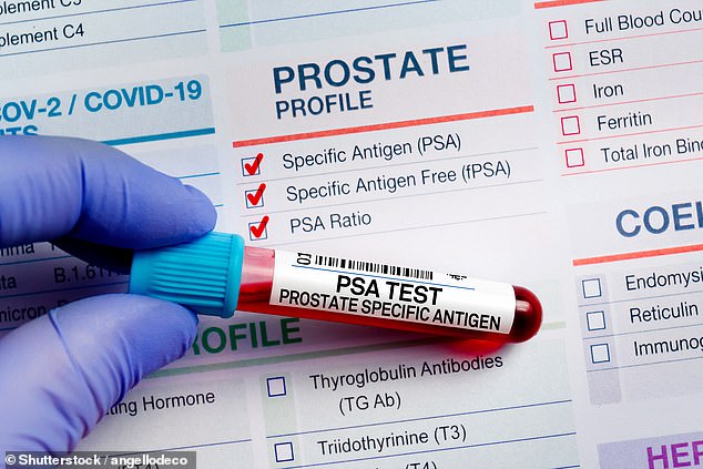 Una revisión histórica confirma que la detección del cáncer de próstata salva vidas