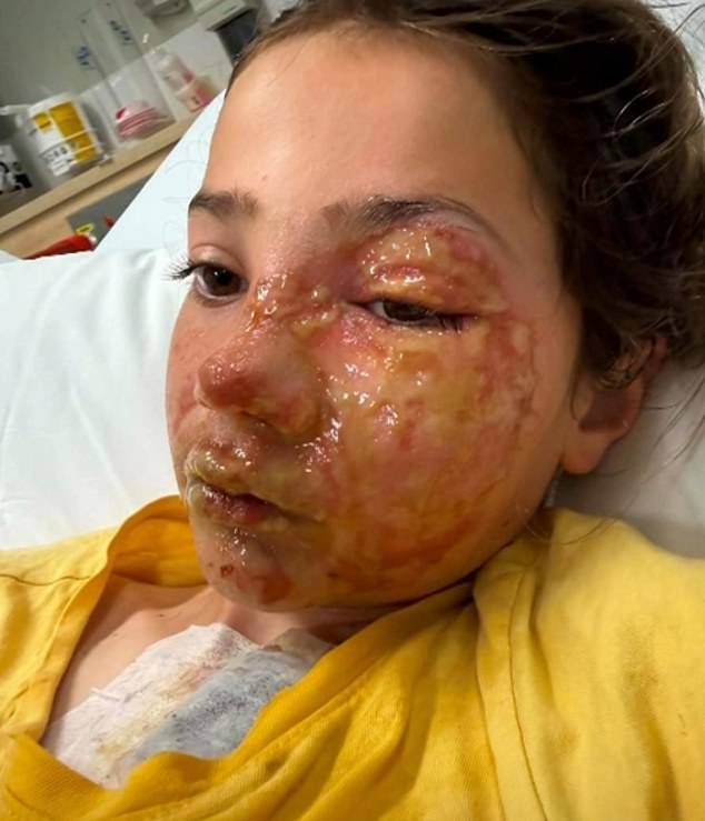 Advertencia de emergencia emitida por un padre después de que su hija, de 10 años, sufriera horribles quemaduras en la cara debido a la tendencia viral de juguetes blandos popular en TikTok
