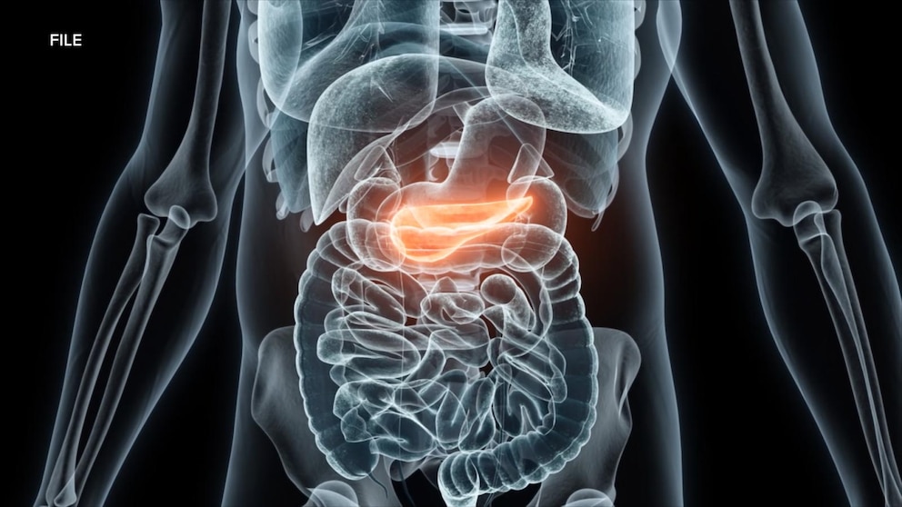MIRAR: Cómo un nuevo fármaco podría prolongar la vida de los pacientes con cáncer de páncreas