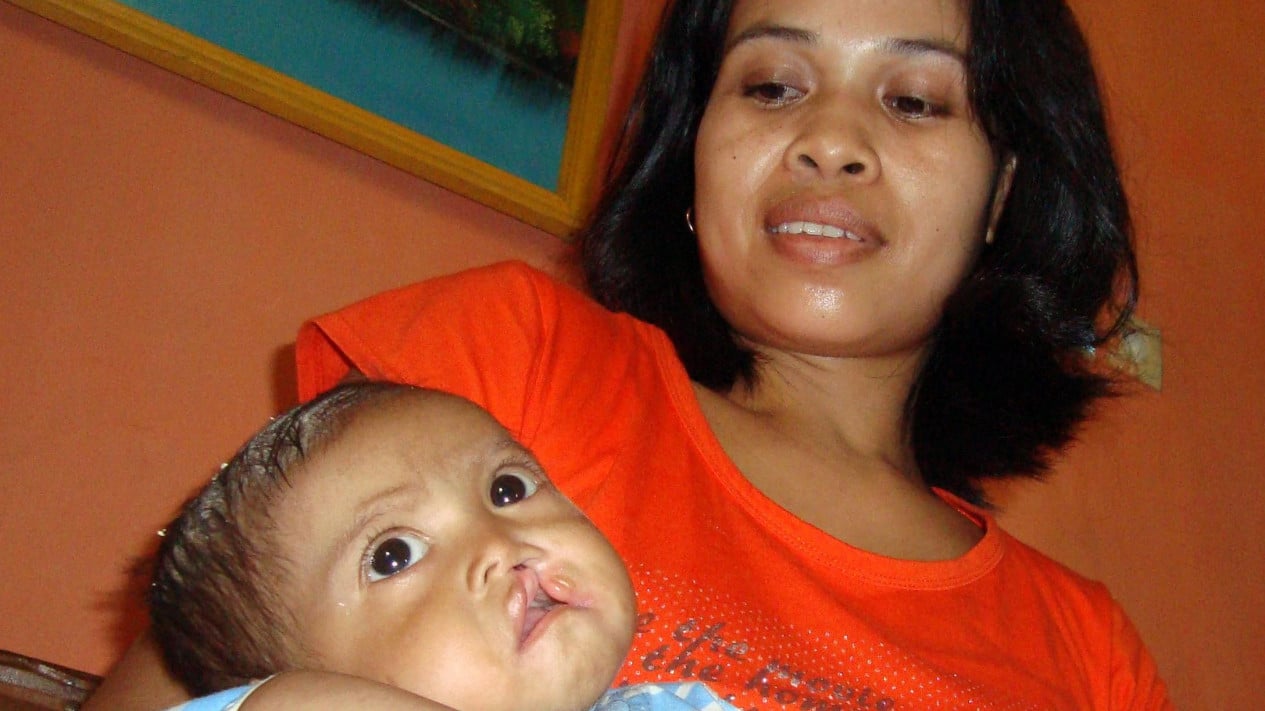 Miles de bebés nacen con labio leporino, reconocen los riesgos y la importancia de la cirugía temprana