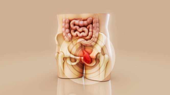 69460d5c4be7c-ilustrasi-hernia_665_374.jpg