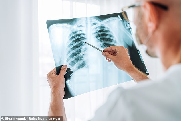 Escaneos de supermercados para detectar su cáncer: el esquema del NHS detecta miles de casos de cáncer de pulmón de manera temprana