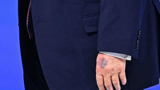 Trump_hand_bruise_1769126123525_1769126123642.jpg