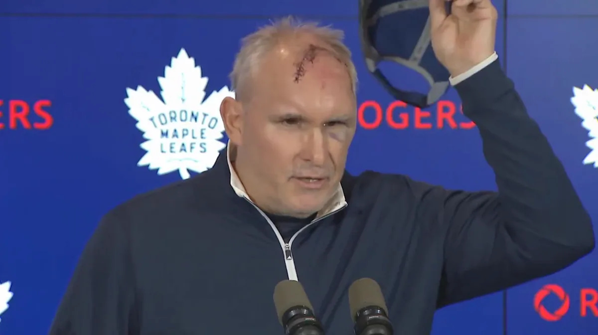 El entrenador de los Maple Leafs, Craig Berube, dice que sufrió un corte horrendo y un ojo magullado en un “estúpido” accidente en el gimnasio